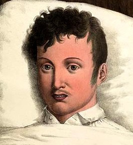 Patient in Acute Stage of Yellow Fever